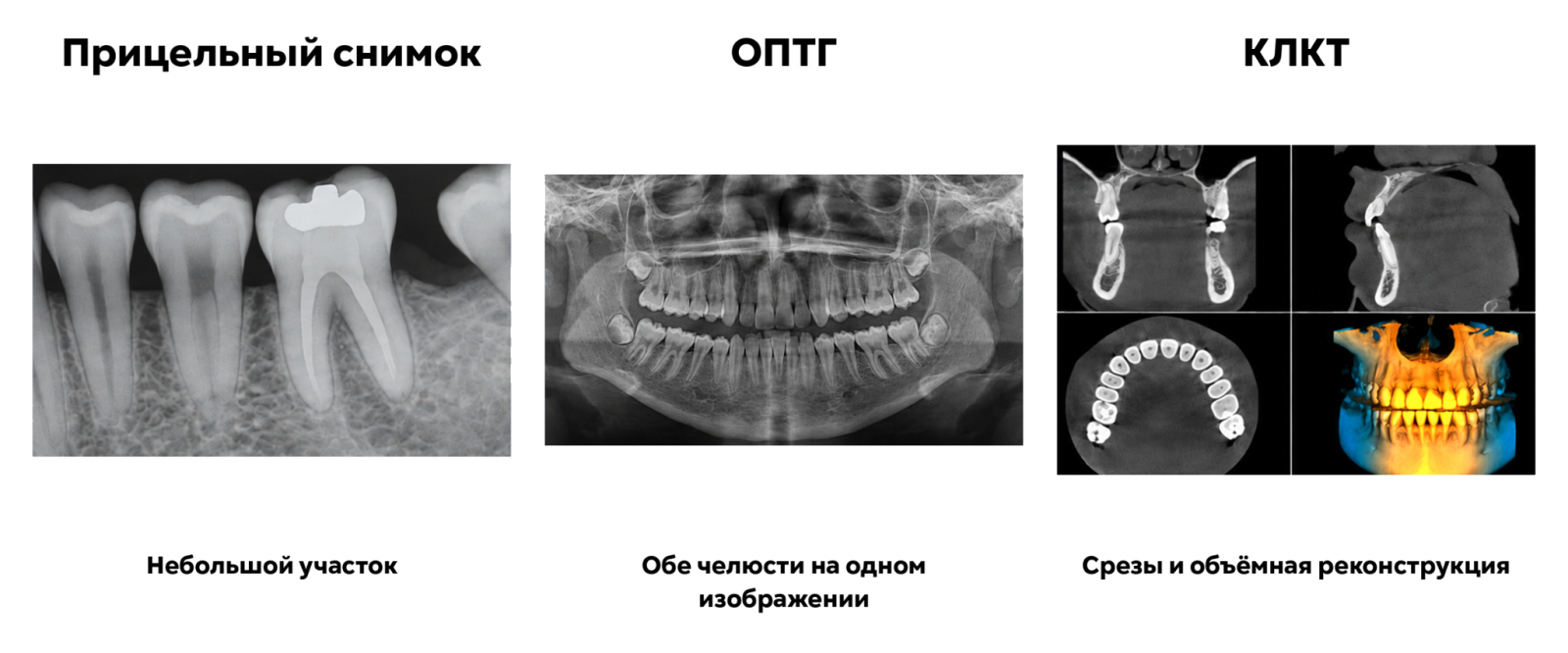 Прицельный снимок, ОПТГ и КЛКТ: сравнение изображений