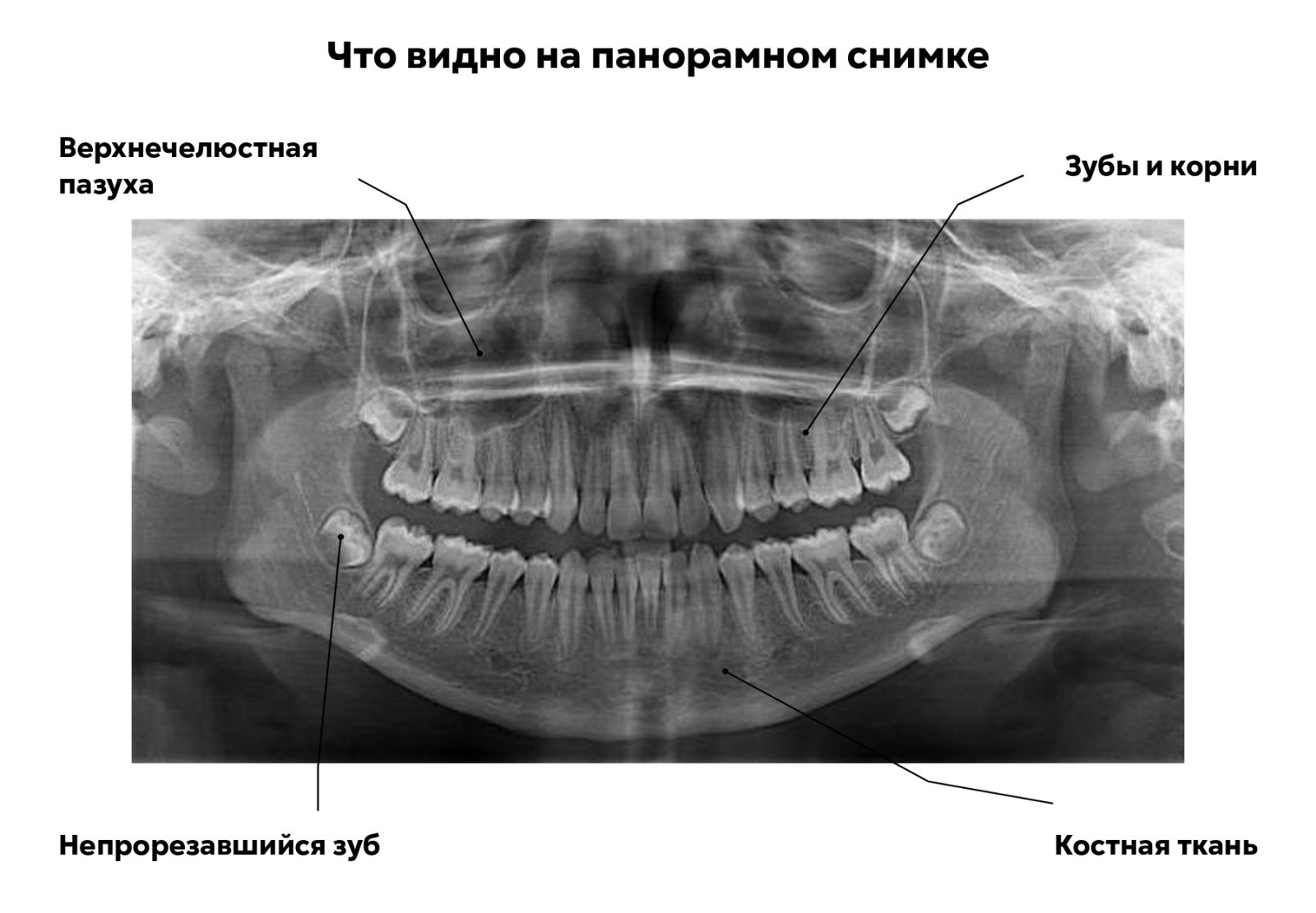 Панорамный снимок зубов и челюстей — ОПТГ