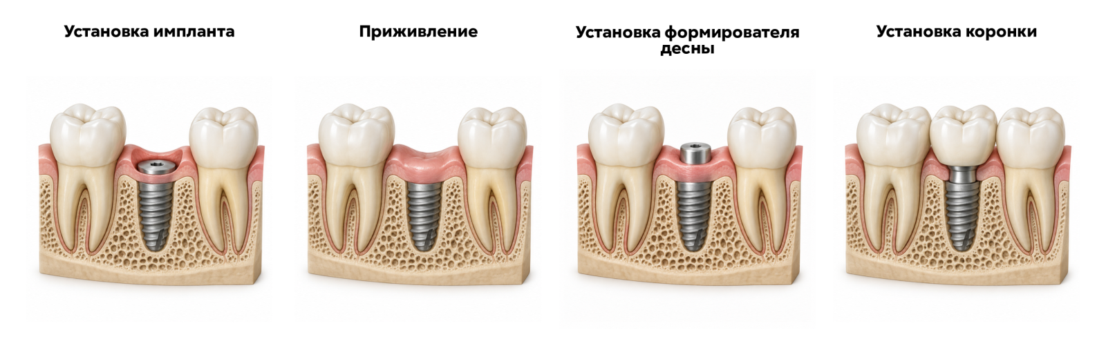 Двухэтапная имплантация: установка импланта, приживление, формирователь десны и коронка