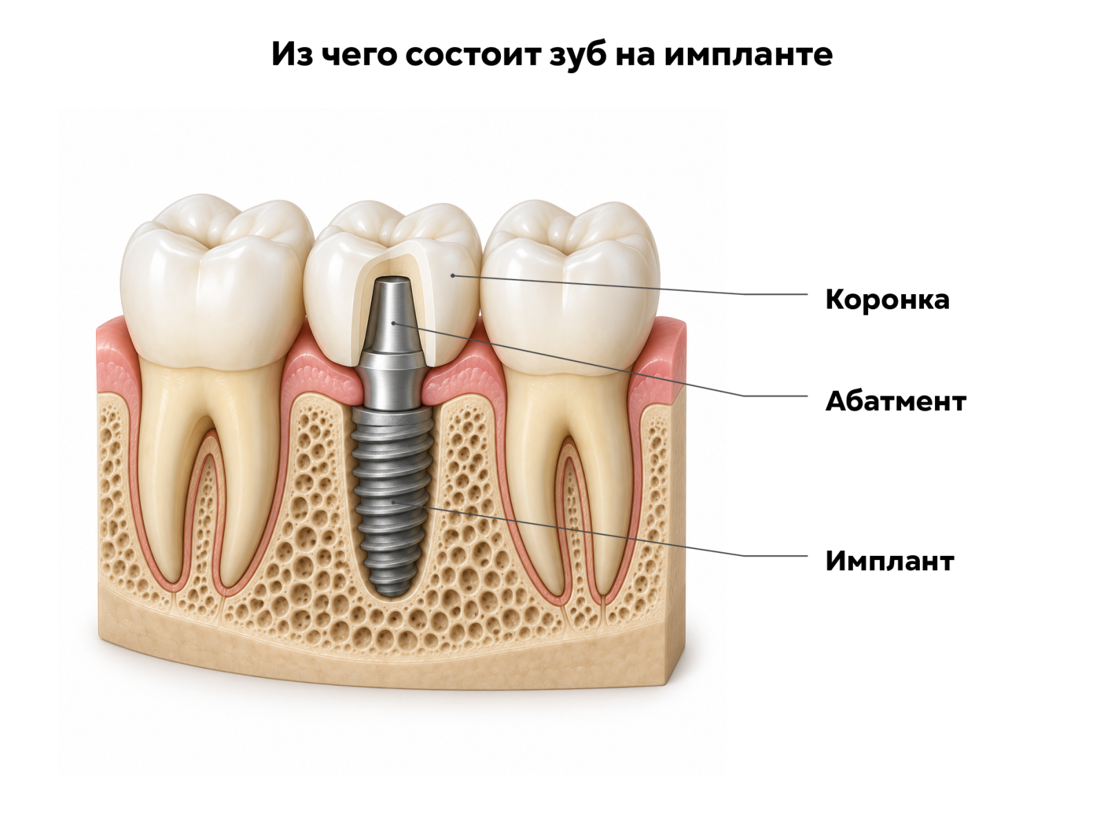 Имплант, абатмент и коронка: состав конструкции