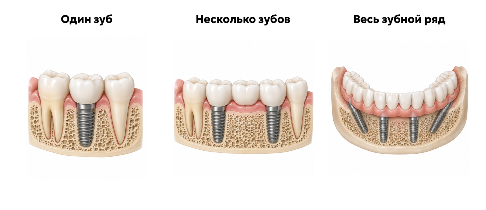 Коронка, мост и протез зубного ряда с опорой на импланты