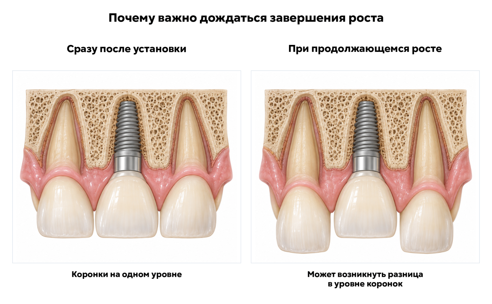 Изменение уровня соседних зубов и коронки на импланте при росте челюсти