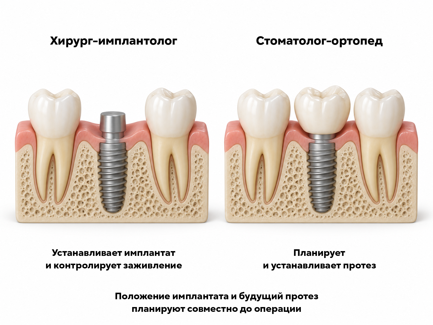 Хирургический и ортопедический этапы: имплантат без коронки и имплантат с коронкой