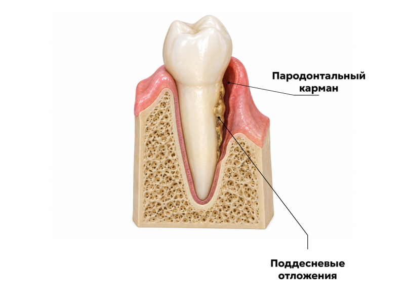 Пародонтальный карман и зубные отложения на поверхности корня под десной
